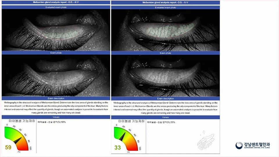 적외선 마이봄샘 검사 전후 영상