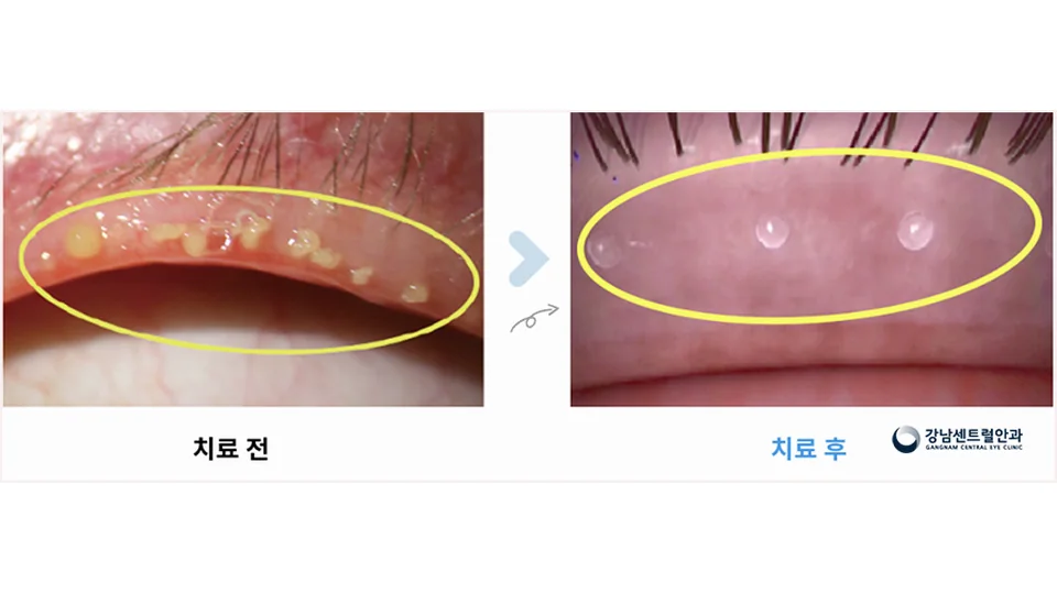 마이봄샘 치료 전후 눈꺼풀 기름샘 상태 비교