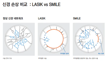 Educational illustration comparing corneal access and nerve patterns in refractive procedures
