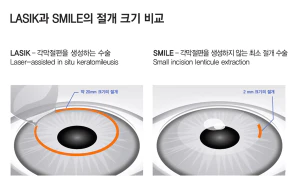 Illustration comparing a small lenticule-extraction incision with a LASIK flap
