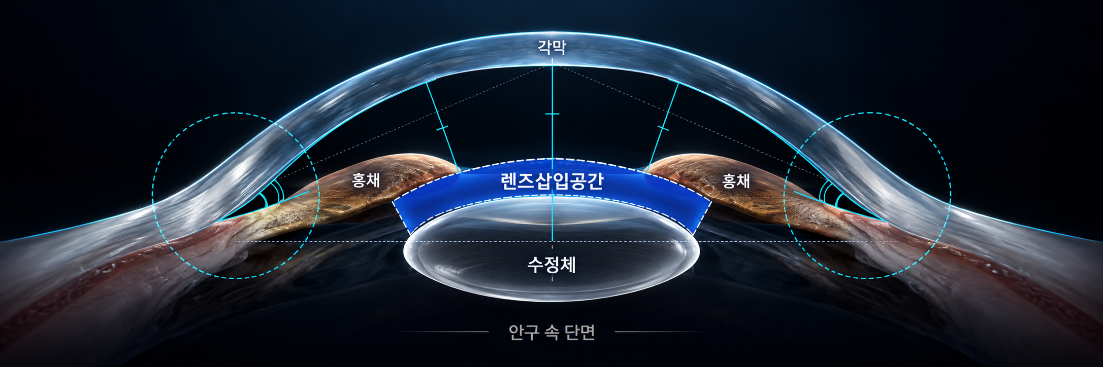 각막·렌즈삽입공간·수정체를 보여주는 안구 측 단면 그래픽