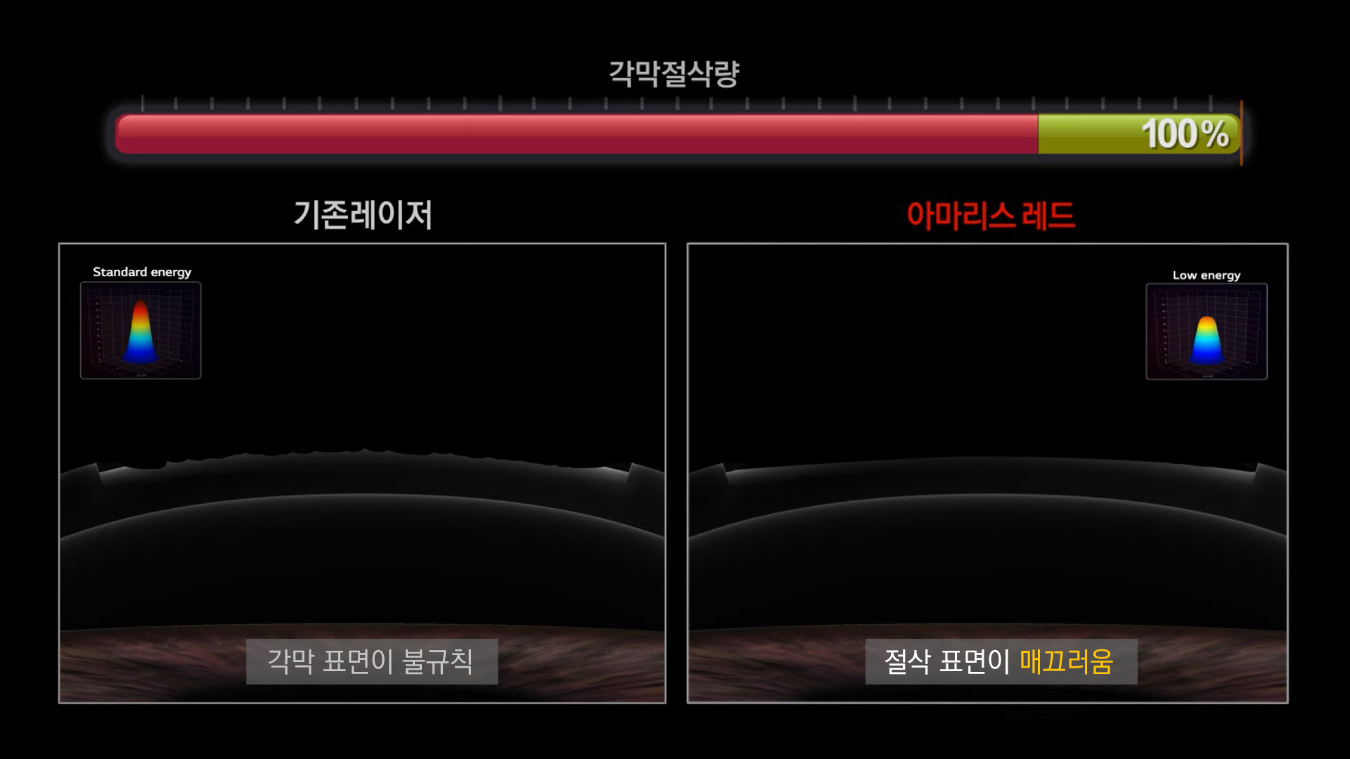 스마트펄스 방식을 나타낸 장비 화면