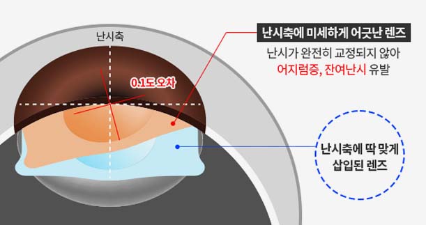 난시축에 맞춘 렌즈 삽입을 나타낸 그래픽